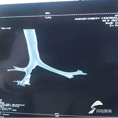 震惊！聊城9岁男童咳嗽50多天，吃药打针不见好，竟是因为…