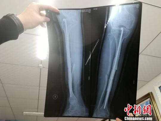双胞胎“瓷娃娃”卧病在床10余年 自学画画开画室